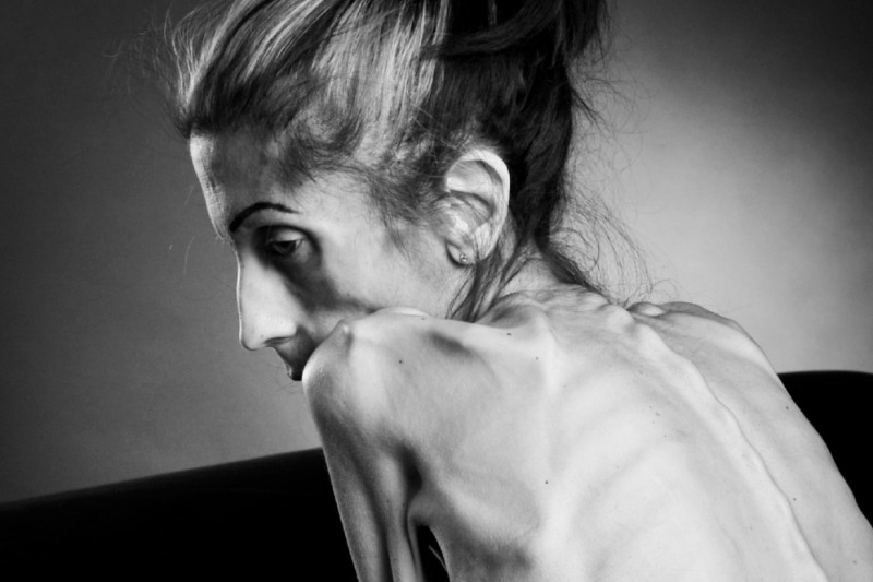 el caso de anorexia de Rachel Farrokh