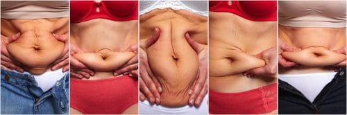 cómo se almacena la grasa abdominal