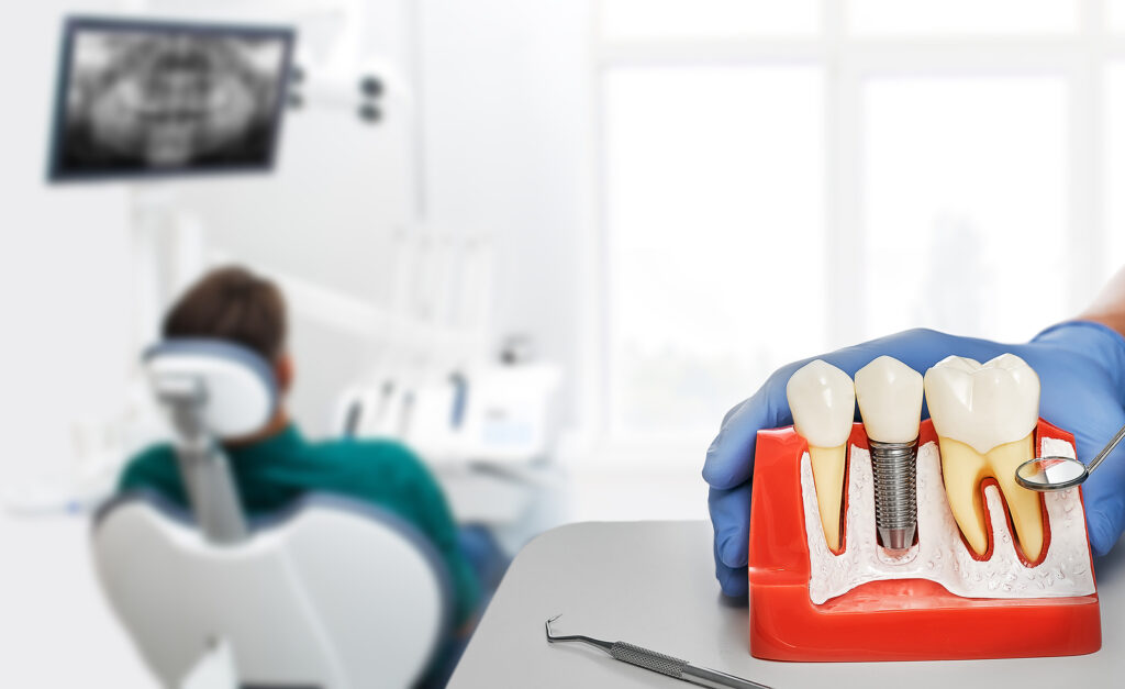 implantes dentales, cuidados de implantes dentales, causas de pérdida de implantes dentales, infección implante dental síntomas, complicaciones de los implantes dentales